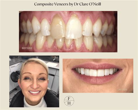 composite teeth veneers|composite bonded veneers.